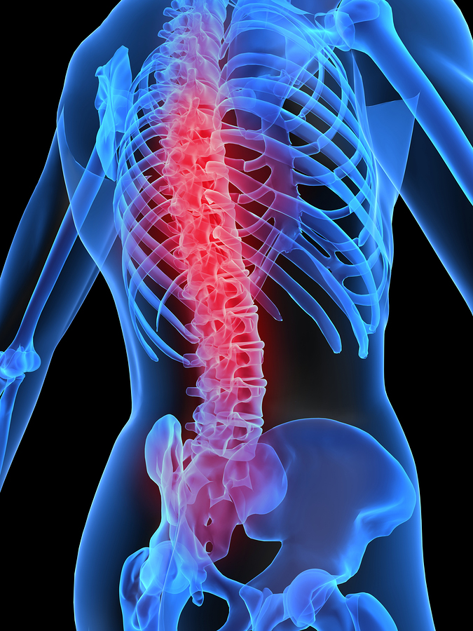 San Diego Herniated Disc Attorney